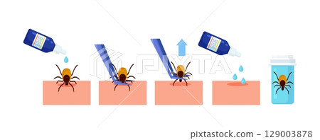Removing encephalitis ticks after bite. How to remove mite. Parasite carrying disease. Tick grabbed into skin, it is removed with tweezers. First aid. Prevention of infections transmitted by mites 129003878