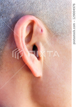 A preauricular sinus appears as a very small pit just in front of the external ear, these sinuses can drain a foul smelling discharge, and when this happens, they are prone to chronic infection. 129004976