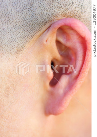 A preauricular sinus appears as a very small pit just in front of the external ear, these sinuses can drain a foul smelling discharge, and when this happens, they are prone to chronic infection. 129004977