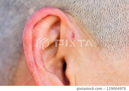 A preauricular sinus appears as a very small pit just in front of the external ear, these sinuses can drain a foul smelling discharge, and when this happens, they are prone to chronic infection. A preauricular sinus appears as a very small pit just in front of the external ear, these sinuses can drain a foul smelling discharge, and when this happens, they are prone to chronic infection. 129004978