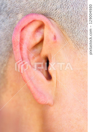 A preauricular sinus appears as a very small pit just in front of the external ear, these sinuses can drain a foul smelling discharge, and when this happens, they are prone to chronic infection. A preauricular sinus appears as a very small pit just in front of the external ear, these sinuses can drain a foul smelling discharge, and when this happens, they are prone to chronic infection. 129004980