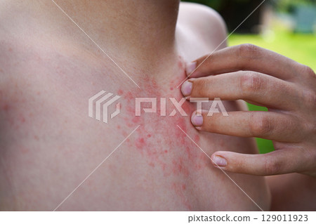 A boy rubs his hand over skin rashes resulting from allergies or hives. Skin conditions, dermatology. A boy rubs his hand over skin rashes resulting from allergies or hives. Skin conditions, dermatology. 129011923