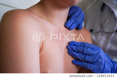 The physician is examining the boy for symptoms of smallpox-like illness. 129011933