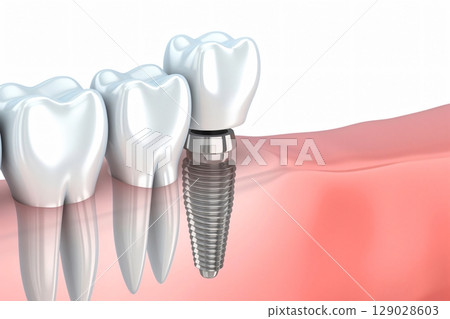 3d rendering shows a dental implant being placed in gums, highlighting modern dentistry and oral health 129028603