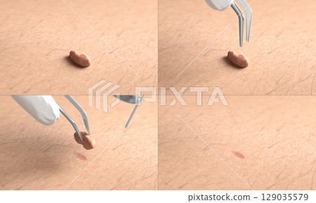 Skin surface with papilloma laser removal treatment process macro 129035579