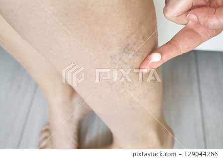 Woman applies cream to her legs with spider varicose veins close-up Woman applies cream to her legs with spider varicose veins close-up 129044266