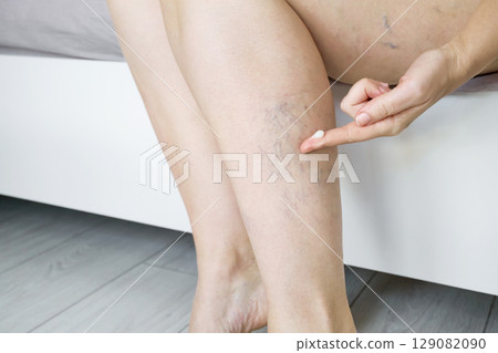 Woman sits on bed and applies cream to her legs with varicose veins 129082090