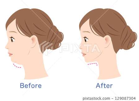雙下巴和瘦下巴 - 前後對比 雙下巴和瘦下巴 - 前後對比 129087304