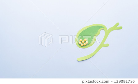 Gallbladder with gallstones (cholelithiasis) anatomy made from paper on blue background. Gallstone blocks the flow of bile through your biliary system causing cholecystitis, pancreatitis, cholangitis. 129091756