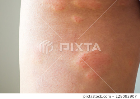 Young asian man has allergic skin rash on his legs from itchy dry skin eczema dermatitis insect bites 129092907