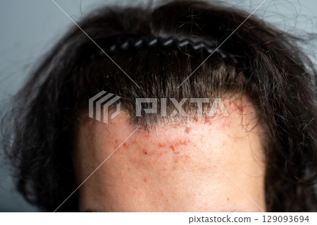 Close-up of a person s forehead with acne and irritation along the hairline, wearing a black hairband. Concept of skin problems, scalp issues, and dermatological care. 129093694