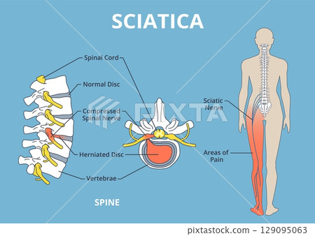 Sciatica pain scheme. Health care medical anatomical poster, vertebrae, spine and spinal cord, herniated disk, education banner design, human silhouette, nowaday vector anatomy infographics Sciatica pain scheme. Health care medical anatomical poster, vertebrae, spine and spinal cord, herniated disk, education banner design, human silhouette, nowaday vector anatomy infographics 129095063