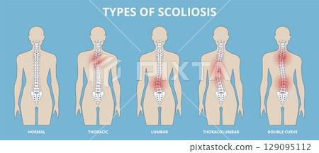 Scoliosis type. Spine curvature, different divisions, medical anatomy scheme, body distortion, vertebrae disease, human skeleton, educational banner, nowaday vector spinal infographic poster Scoliosis type. Spine curvature, different divisions, medical anatomy scheme, body distortion, vertebrae disease, human skeleton, educational banner, nowaday vector spinal infographic poster 129095112