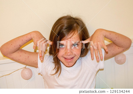 Natural vaccination. Contagious disease. Sick child with chickenpox. Varicella virus or Chickenpox bubble rash on child body and face. High quality photo 129134244