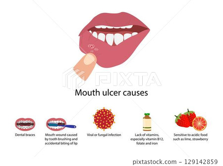illustration of biology and medical, Aphthous ulcer, Mouth ulcer causes, Aphthous stomatitis, An ulcer in the mouth, caused by a break in the mucous membrane illustration of biology and medical, Aphthous ulcer, Mouth ulcer causes, Aphthous stomatitis, An ulcer in the mouth, caused by a break in the mucous membrane 129142859