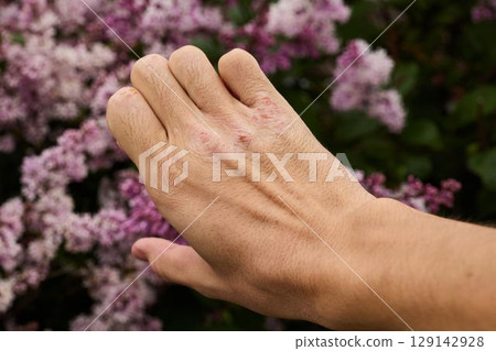A closeup view of a hand exhibiting a skin condition set against a vibrant floral background A closeup view of a hand exhibiting a skin condition set against a vibrant floral background 129142928