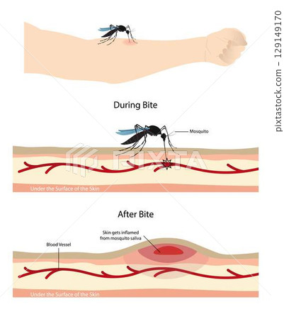 illustration of biology and animals, mosquito sucking blood on human body, Mosquito cartoon sucking blood from human skin, mosquito transmits dengue viruses to humans through bites illustration of biology and animals, mosquito sucking blood on human body, Mosquito cartoon sucking blood from human skin, mosquito transmits dengue viruses to humans through bites 129149170