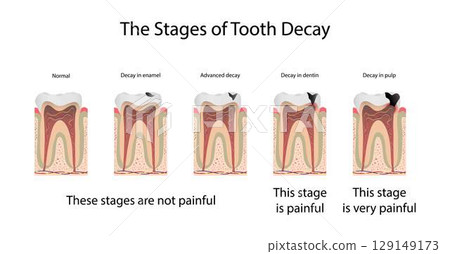 illustration of biology and medical, The stages of tooth decay, Tooth decay is damage that occurs to teeth, Dental plaque is important to the tooth decay process 129149173
