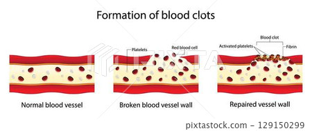 illustration of Biology and medical, Formation of blood clots, Blood clotting normally occurs when there is damage to a blood vessel, A platelet plug is formed, and the external bleeding stops 129150299