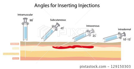 illustration of biology and medical, Angles for inserting injections, Simple drawing of cross section of skin with three needles administering injections at different angles, injection sites illustration of biology and medical, Angles for inserting injections, Simple drawing of cross section of skin with three needles administering injections at different angles, injection sites 129150303