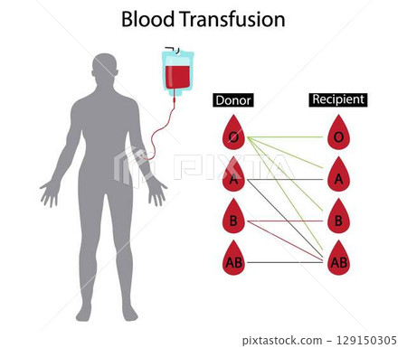 illustration of biology and medical, Blood transfusion is the process of transferring blood products into a person's circulation intravenously, four major blood groups, Donate blood 129150305