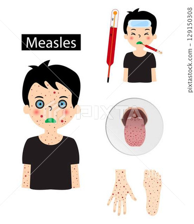 illustration of biology and medical, Measles, infectious disease, Measles is a highly contagious infectious disease caused by measles virus, spots may form inside the mouth after the start of symptoms illustration of biology and medical, Measles, infectious disease, Measles is a highly contagious infectious disease caused by measles virus, spots may form inside the mouth after the start of symptoms 129150308