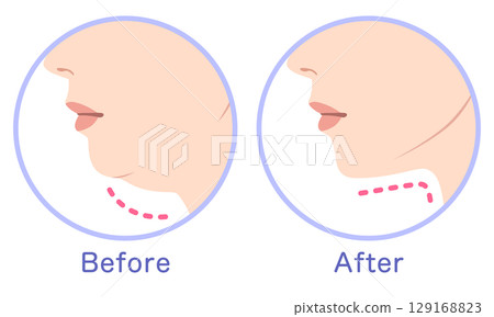 Double chin and slimmer chin - before and after 129168823