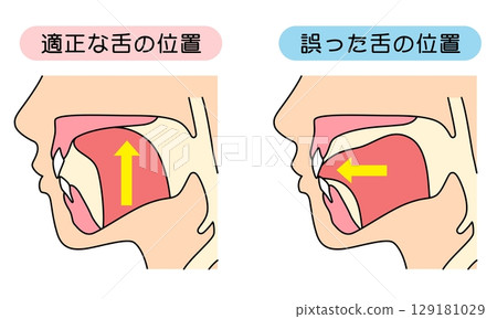 How to mew properly: correct and incorrect tongue position 129181029