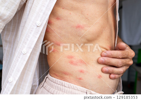 Close-up of Adult Skin with Multiple Red Itchy Mosquito Bites 129185353