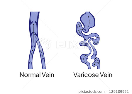 Normal vein and varicose vein with blood flow direction 129189951