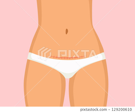 Female Belly with Scar Vector Postpartum Body Concept 129200610