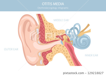 Otitis media. Infection in the middle ear. Otological disorders infographic Otitis media. Infection in the middle ear. Otological disorders infographic 129218827
