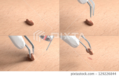Skin surface with papilloma laser removal treatment process macro 129226844