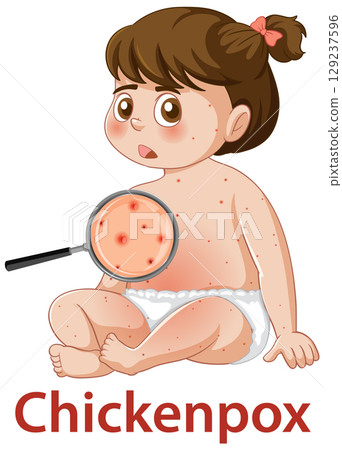 Child with Chickenpox Rash and Magnified Skin Detail Child with Chickenpox Rash and Magnified Skin Detail 129237596