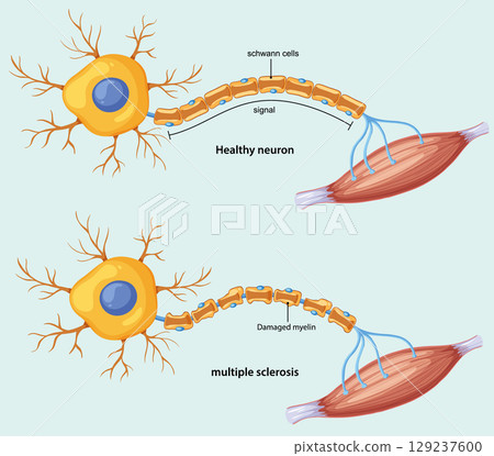 Comparison of Healthy Neuron and Multiple Sclerosis Damage 129237600