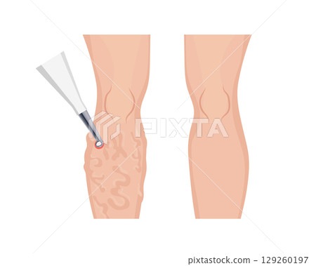 Laser treatment removing varicose veins on patient leg 129260197