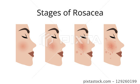 Woman face showing rosacea evolution from stage 1 to 4 Woman face showing rosacea evolution from stage 1 to 4 129260199