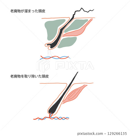 Illustration of a normal scalp and a scalp with accumulated waste products 129266135