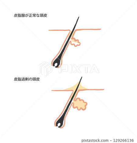 Hand-drawn illustration of hair root and sebum trouble 129266136