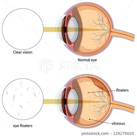 Comparison of Normal Eye and Eye Floaters Illustration 129270020