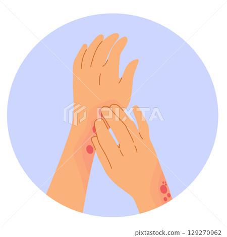 Cartoon Vector of Female Hands Scratching Skin Rash Illustration Cartoon Vector of Female Hands Scratching Skin Rash Illustration 129270962