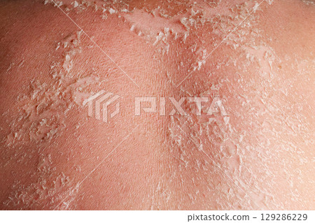 Sunburn on the skin. Skin from the burn texture. Dry skin in need of treatment and hydration. Close up Sunburn on the skin. Skin from the burn texture. Dry skin in need of treatment and hydration. Close up 129286229