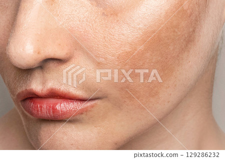 Womans face with pigmentation, melasma, freckles, age spots photo. Close up photo texture 129286232