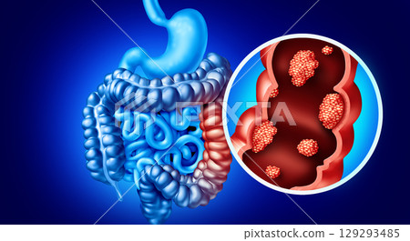 Colorectal Cancer 129293485