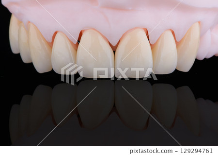 High-quality eight dental crowns made of zirconium for fixation to the frontal teeth of upper jaw. 129294761