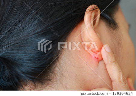Close-up of skin infection behind the ear showing redness, inflammation, and irritation. Dermatological problem, eczema or fungal infection concept. Medical skincare issue. 129304634
