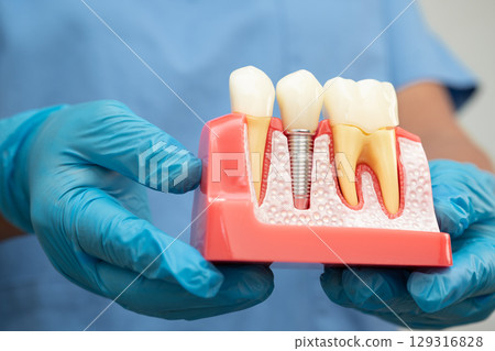 Dental implant, artificial tooth roots into jaw, root canal of dental treatment, gum disease, teeth model for dentist studying about dentistry. 129316828