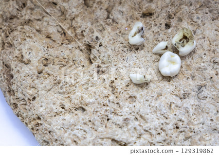 Five extracted baby teeth lie on a stone background. 5 decayed baby teeth affected by caries. Five extracted baby teeth lie on a stone background. 5 decayed baby teeth affected by caries. 129319862