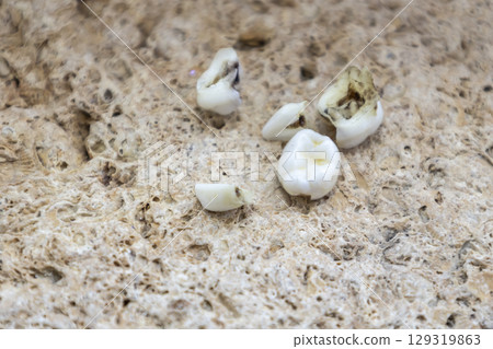 Five extracted baby teeth lie on a stone background. 5 decayed baby teeth affected by caries. Five extracted baby teeth lie on a stone background. 5 decayed baby teeth affected by caries. 129319863