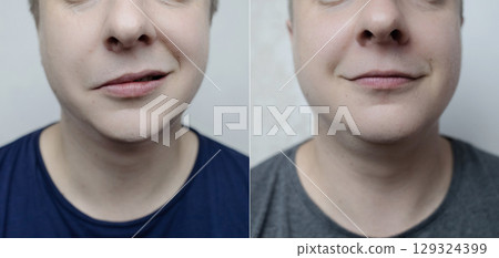 Before and after comparison of a young person with facial nerve palsy, Bells palsy. Concept of neurology, recovery, treatment success, and medical 129324399